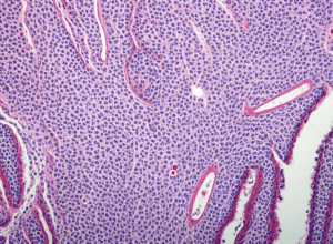 Cancer pancreatic: Mecanism cheie descoperit